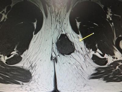 Proximal-type epithelioid sarcoma of the perineum: A case report and literature review